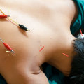 The Healing Power of Acupuncture for Dizziness