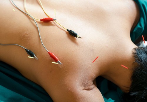 The Healing Power of Acupuncture for Dizziness